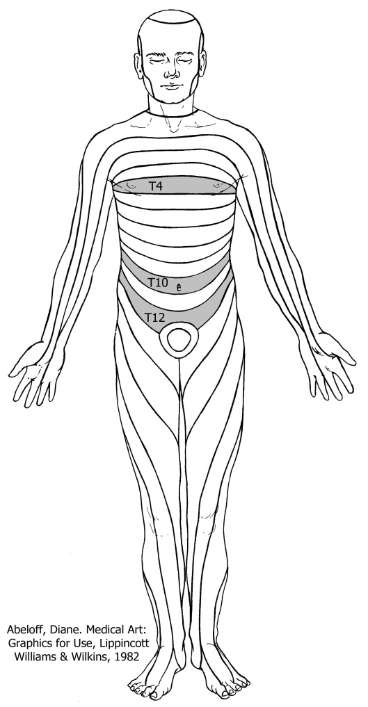 Diagram showing the dermatomes of the human body with the T4, T10, and T12 dermatomes highlighted.