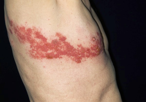 Photograph of a person with shingles rash on T4 dermatome.