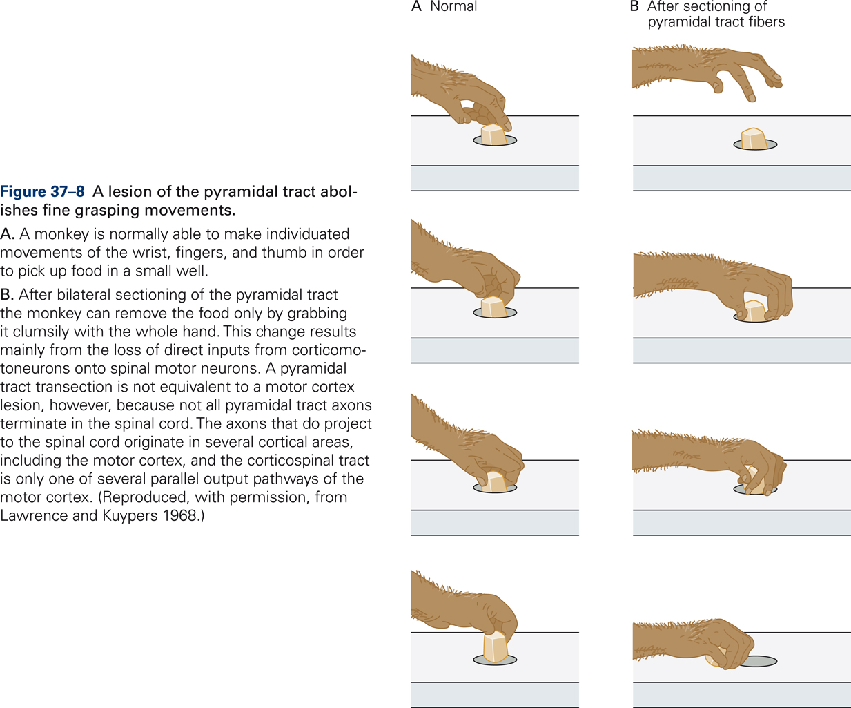 Lesions of the corticospinal tracts abolish fine finger movements.