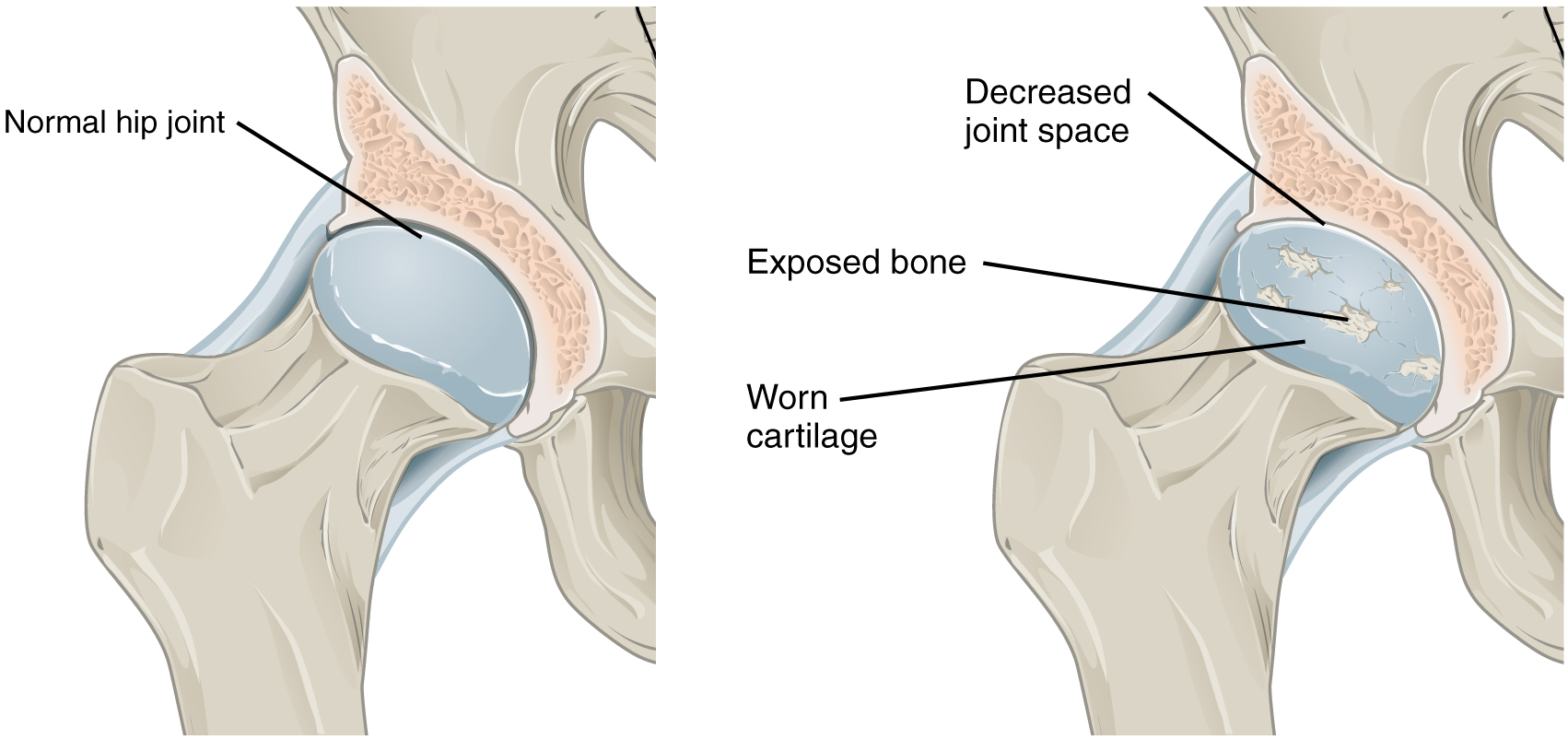 The top panel in this figure shows a normal hip joint, and the bottom panel shows a hip joint with osteoarthritis.