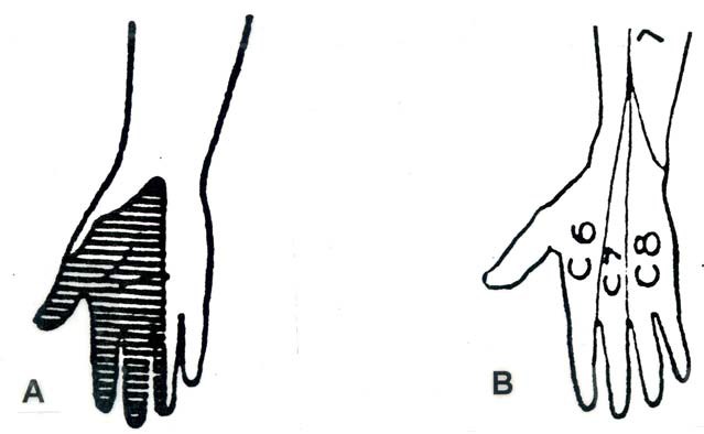 Distribution of sensory branches of median nerve in the hand compared to dermatomes in the hand.