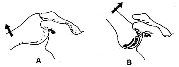 Diagram showing the limitations on abduction of the glenohumeral joint due to the acromion of the scapula and showing how lateral rotation and inferior sliding of the humeral head reduce those limitations.
