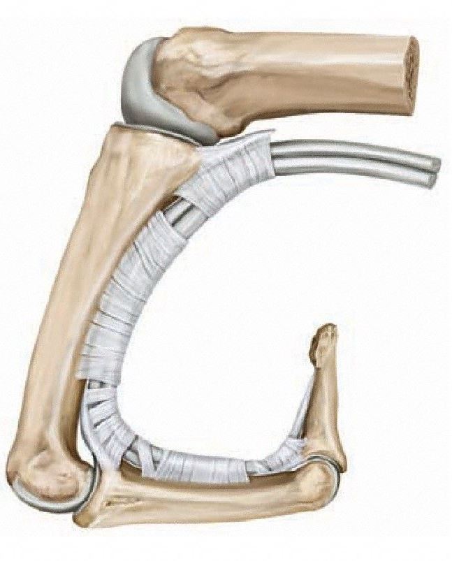 View of bony articulations at the metacarpophalangeal joint. When the finger is flexed (as shown), the articular surface of the head of the metcarpal is flat. When the finger is extended, the articular surface of the metacarpal than apposes the proximal phalanx is rounded. From Schuenke et al., THIEME Atlas of Anatomy, THIEME 2007, pp. 250-251.