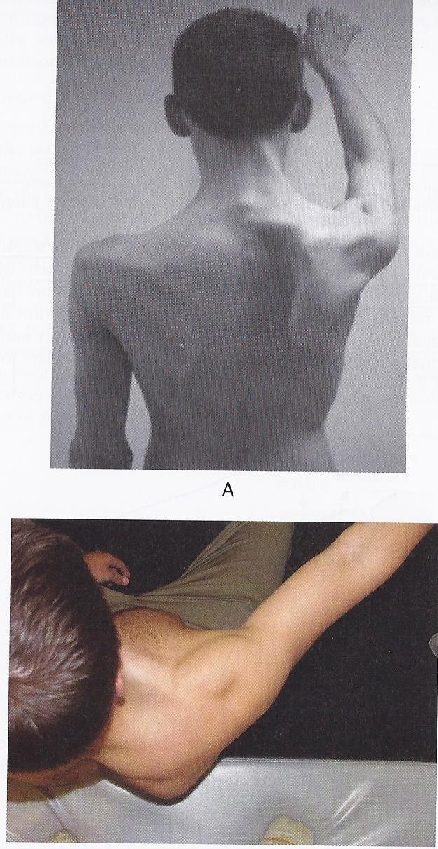 Cropped-Winging of Scapula