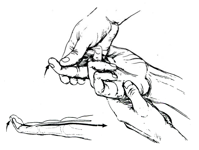 Testing for Function of Flexor Digitorum Profundus: Flexion of the DIP Joint. From Hoppenfeld, S., Physical Examination of the Spine and Extremities; 1976 , Appleton-Century-Crofts, New York; p. 99.