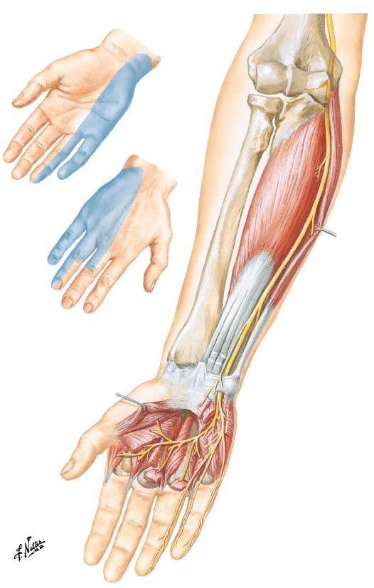 Course and anatomical relationships of the Ulnar Nerve. At upper left is the cutaneous distribution of the ulnar nerve in the hand. From Netter Presenter.