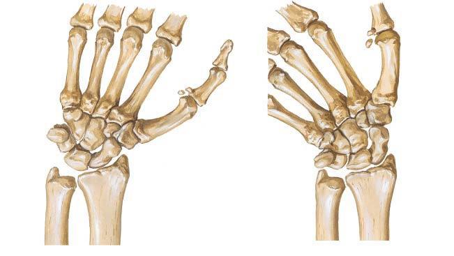 Abduction (left; also "radial deviation") and adduction (right; also "ulnar deviation") of the wrist joint. From Netter Presenter.
