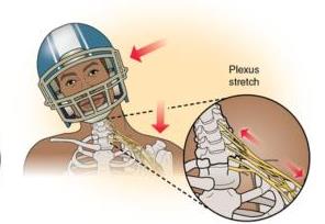 Illustration of method of injuring the upper brachial plexus