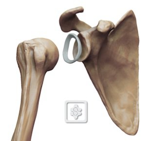 The shallow glenoid fossa, is deepened slightly by the glenoid labrum, a ring of fibrocartilage encircling the glenoid fossa. From https://www.shoulderdoc.co.uk/article/1463