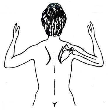 An illustration depicting an individual with loss of function of both serratus anterior and trapezius. The person is unable to aBduct their arms above their head because of the inability to rotate the scapula. The glenoid fossa begins to face posteriorly because of the inability to hold the scapula in its normal position.