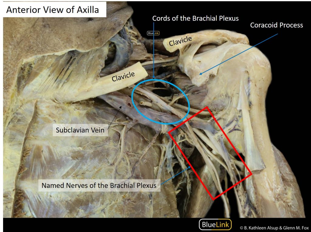 Photograph of a dissection showing the cords and named nerves of the brachial plexus in the axillary fossa