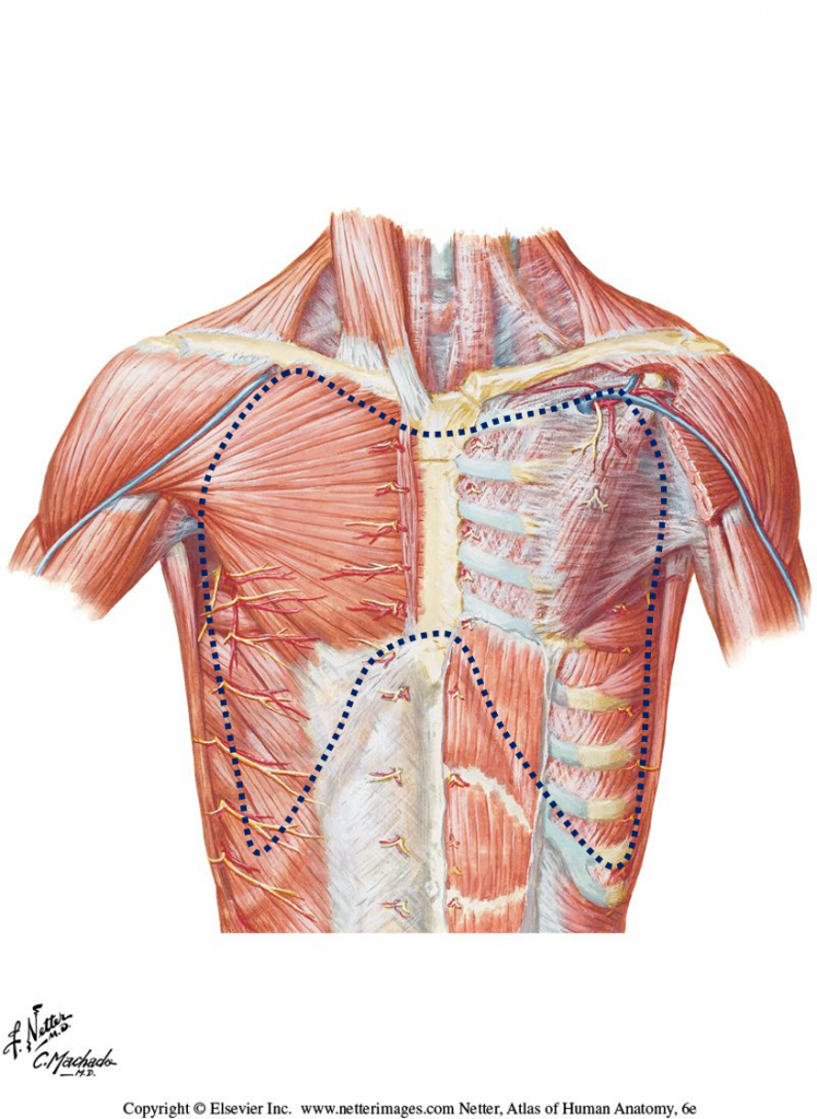 Diagram of incision lines for thoracic wall removal.